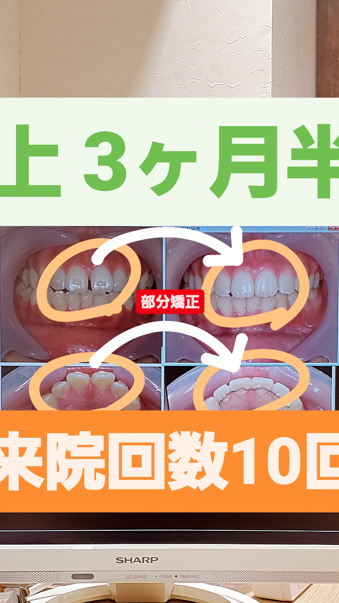 すきっ歯+出っ歯