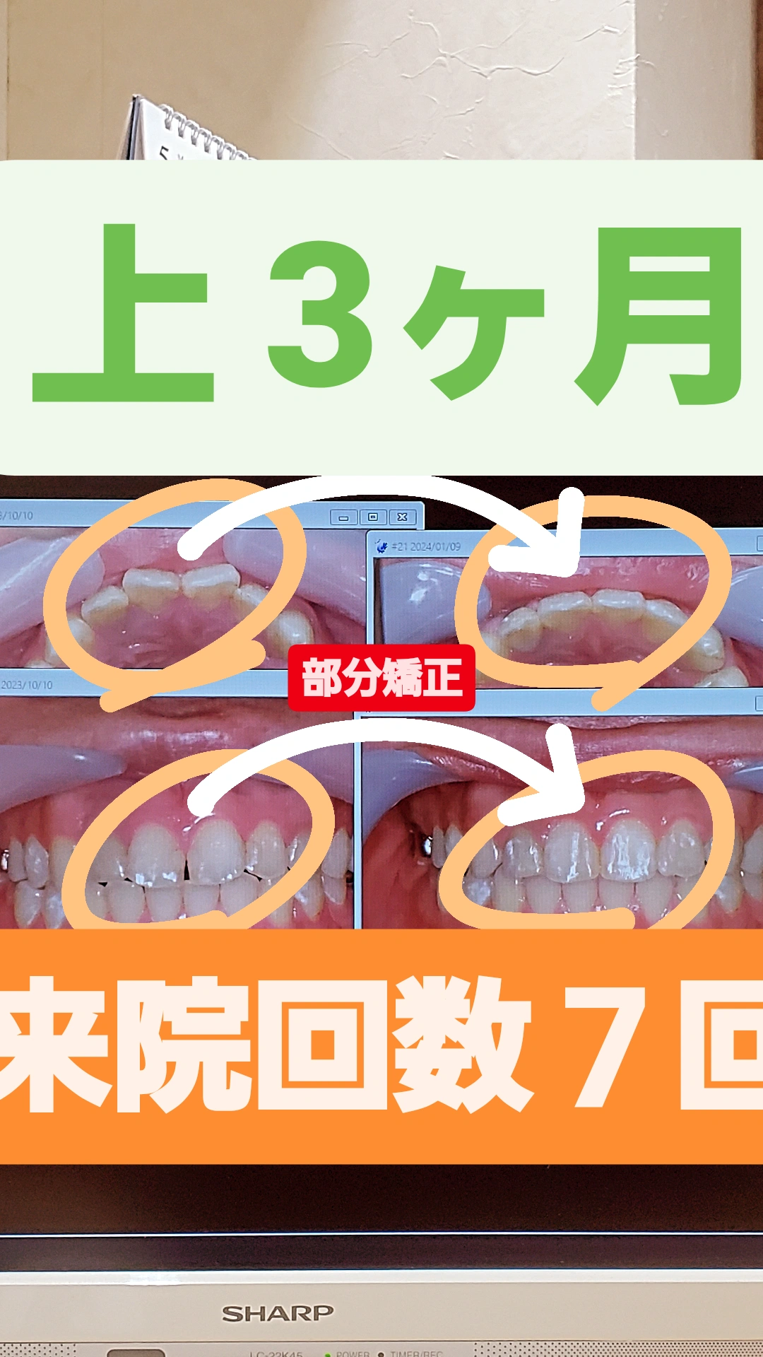 出っ歯＋すきっ歯