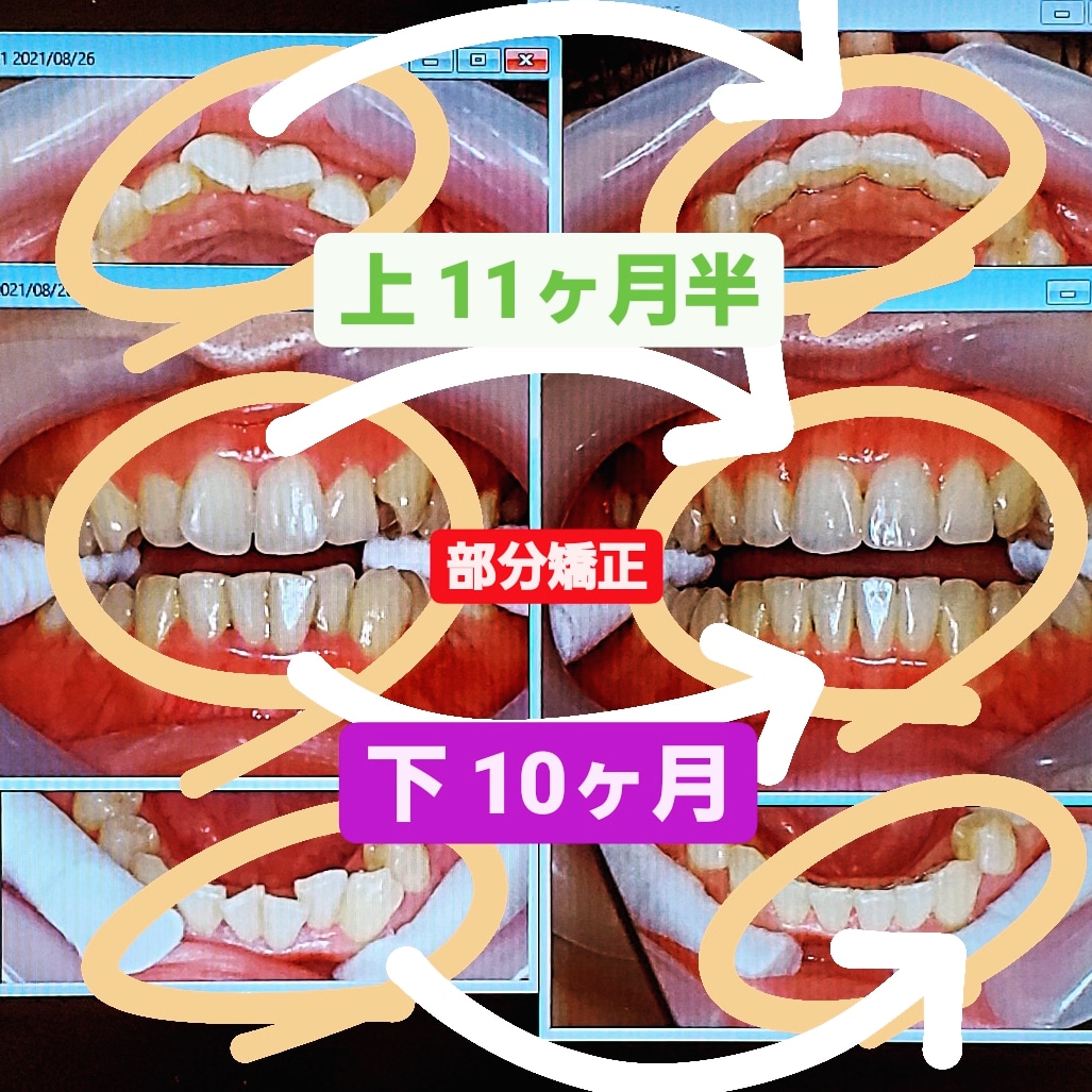 叢生＋出っ歯＋少し八重歯