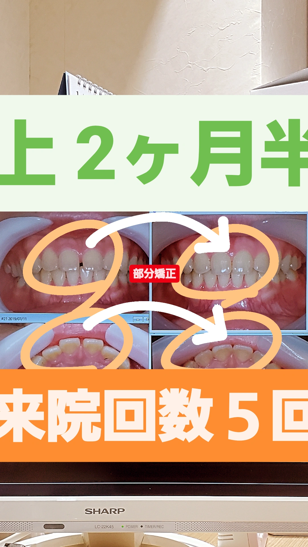 すきっ歯+出っ歯