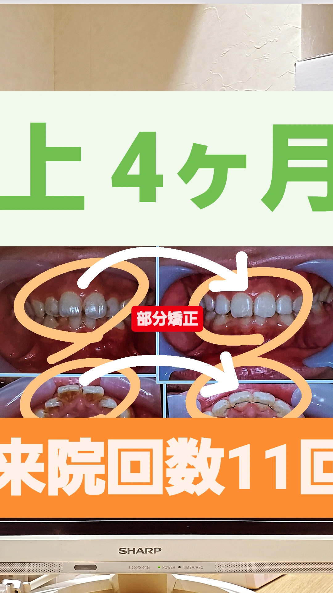 すきっ歯+出っ歯