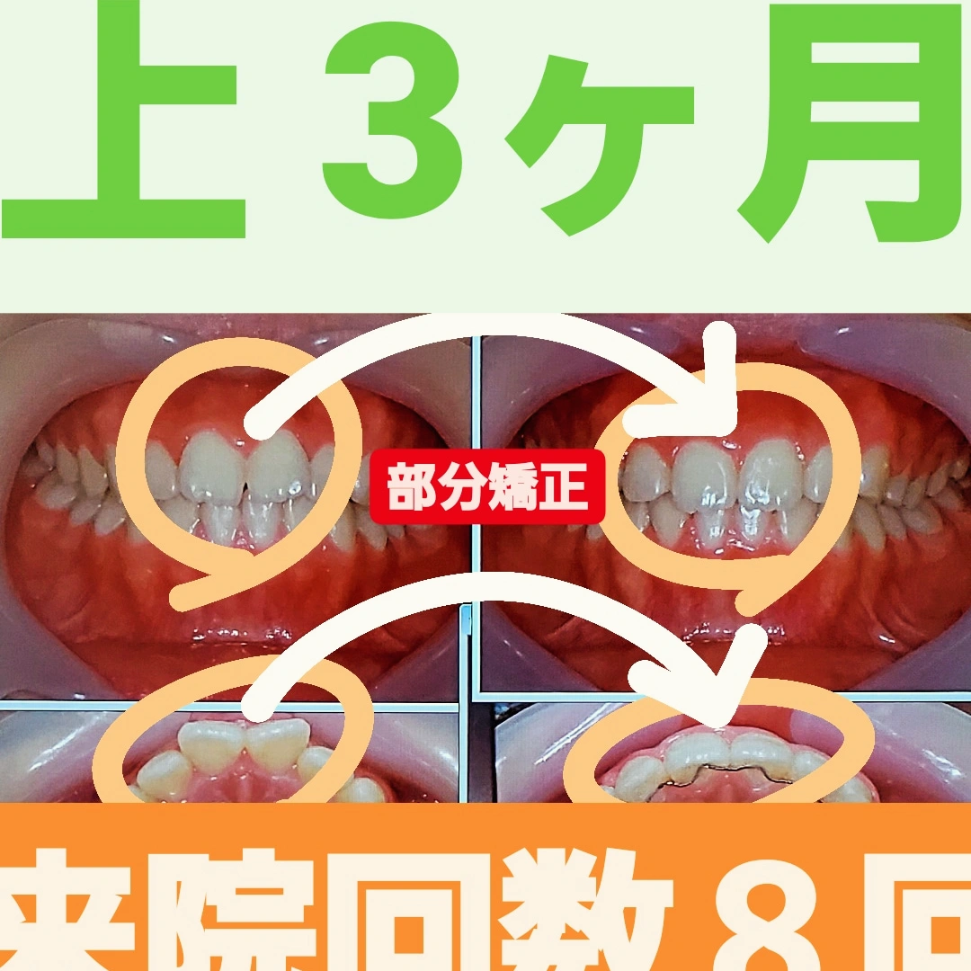 すきっ歯+出っ歯