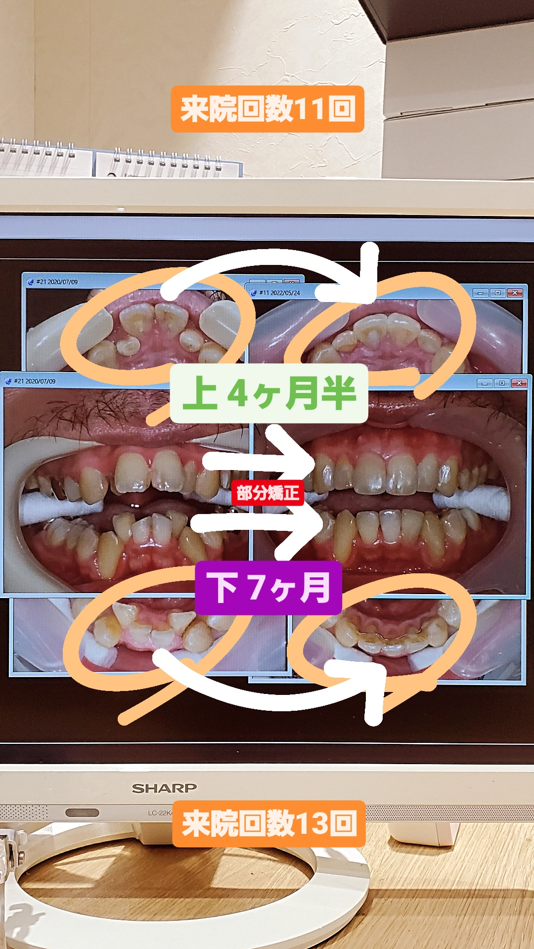 咬合＋叢生＋出っ歯