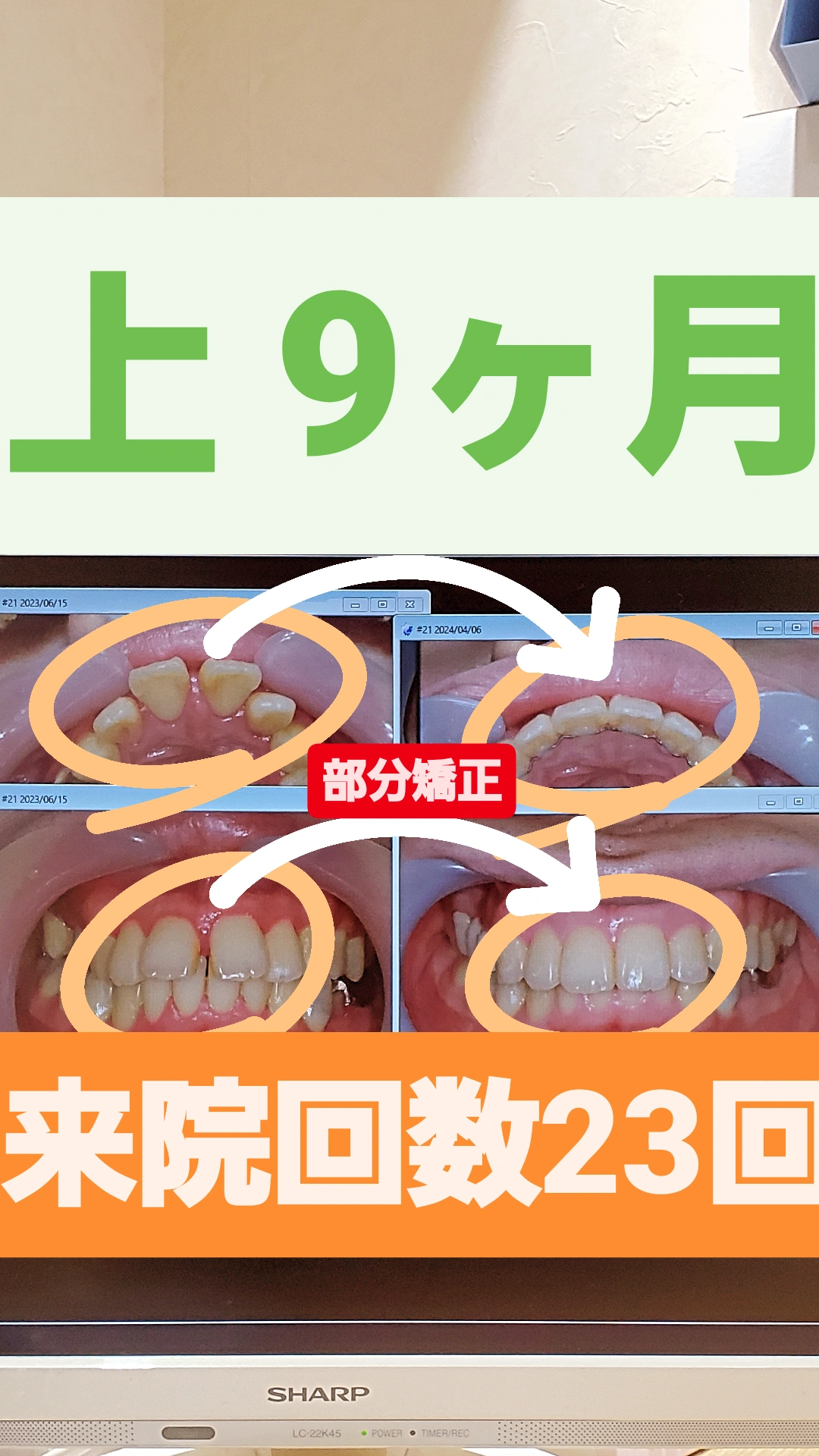 出っ歯+すきっ歯