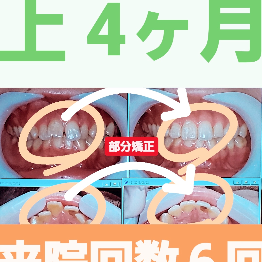 すきっ歯＋出っ歯