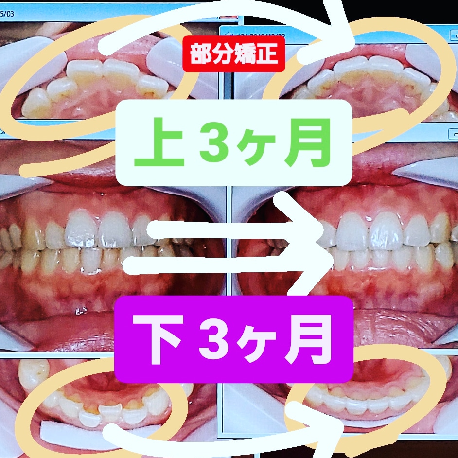 叢生＋出っ歯