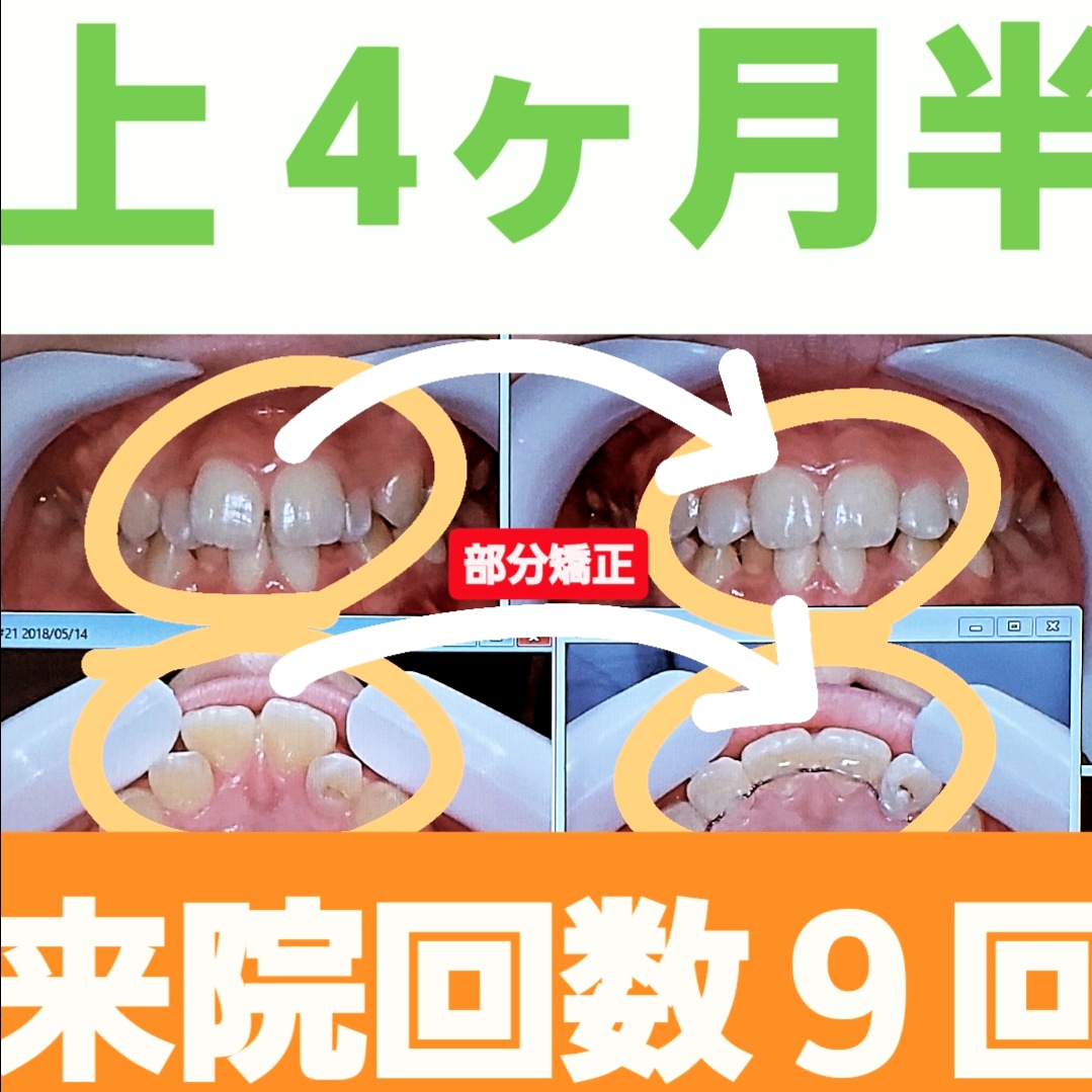 すきっ歯＋出っ歯