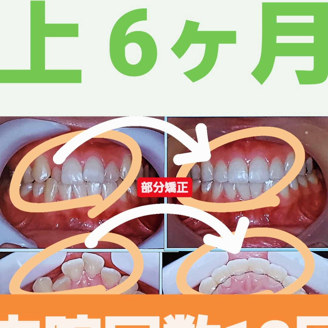 出っ歯＋叢生＋反対咬合