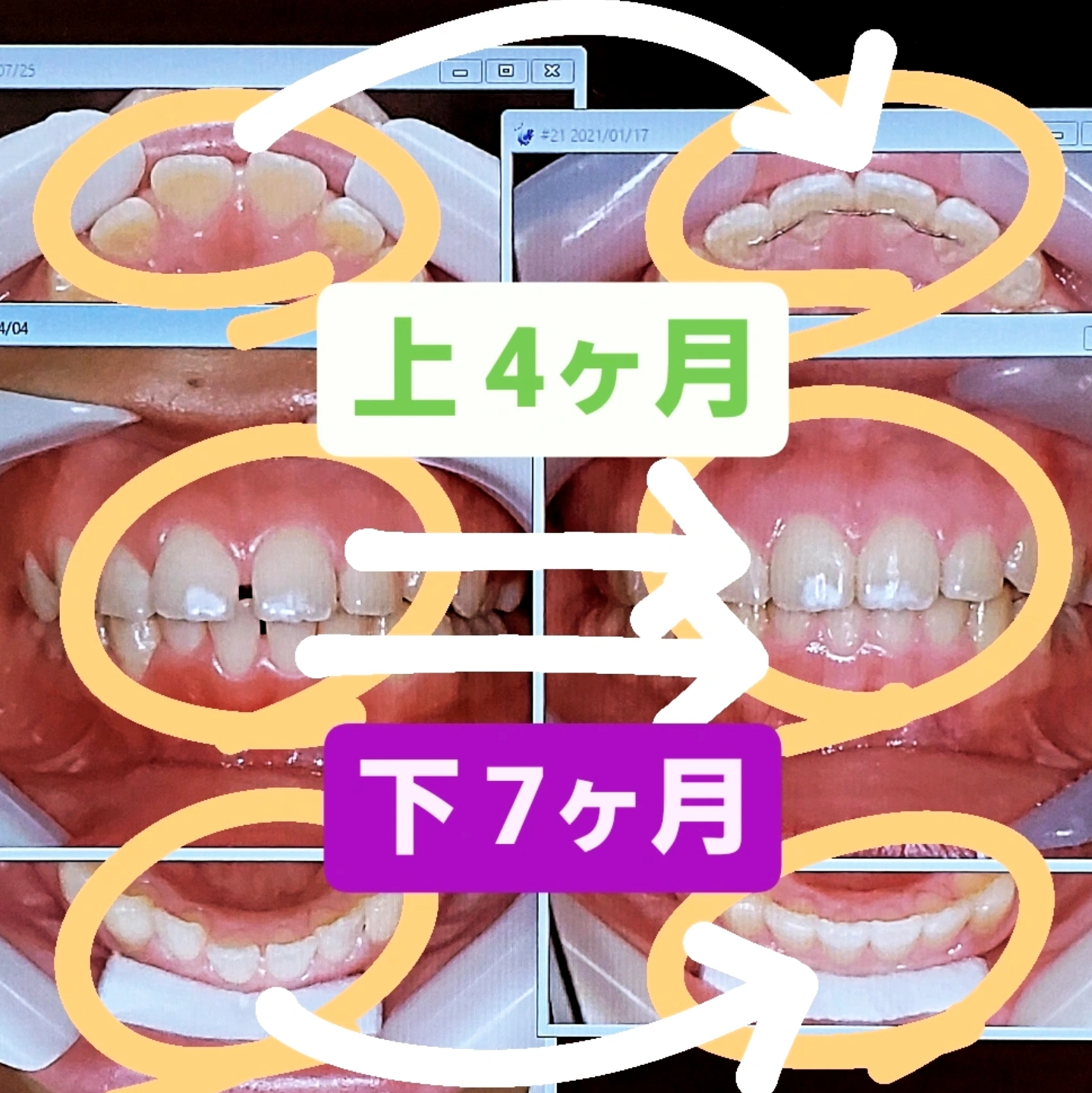 すきっ歯＋出っ歯